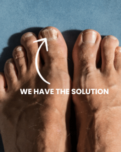 Read more about the article Bid Farewell to Toenail Fungus from the Comfort of Your Home